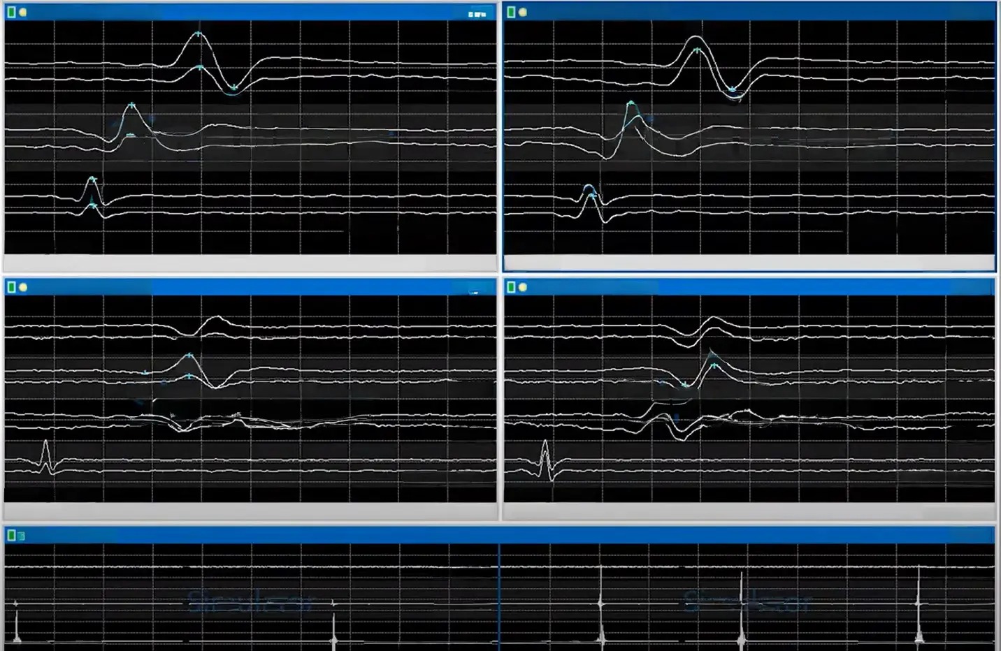 Ultrasonik Aspiratör